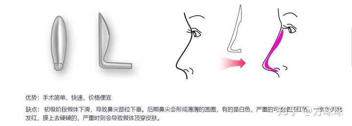 隆鼻综合手术费用解析，价格、因素与价值考量
