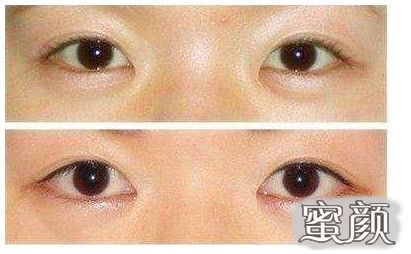 明星开眼角前后的华丽蜕变，从自然到惊艳的秘密