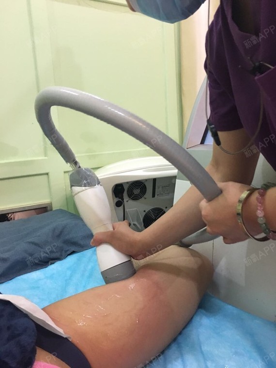 激光溶脂，重塑美腿的科技新选择——解析激光溶脂瘦大腿的奥秘