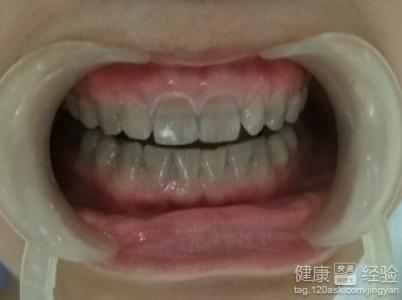 四环素牙美白，价格、效果与选择考量