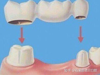 镶牙与种植牙，费用、差异与选择指南