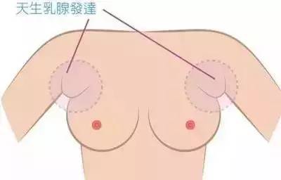 副乳吸脂，重塑自信的美丽选择
