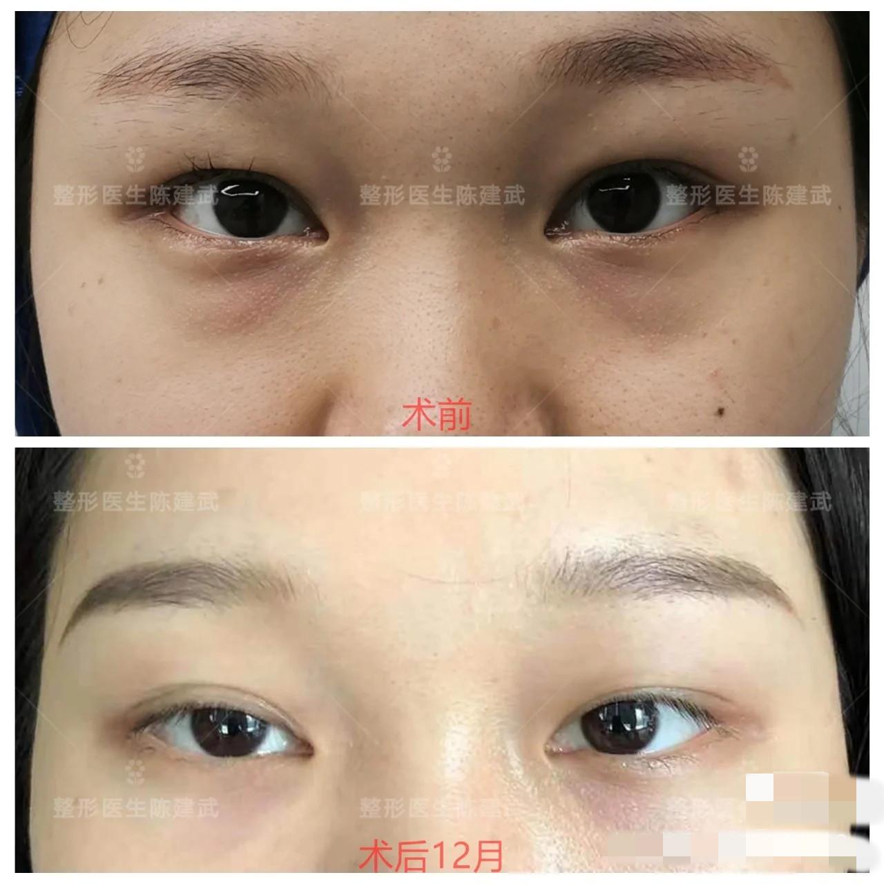 开外眼角手术，疼痛与美丽的权衡