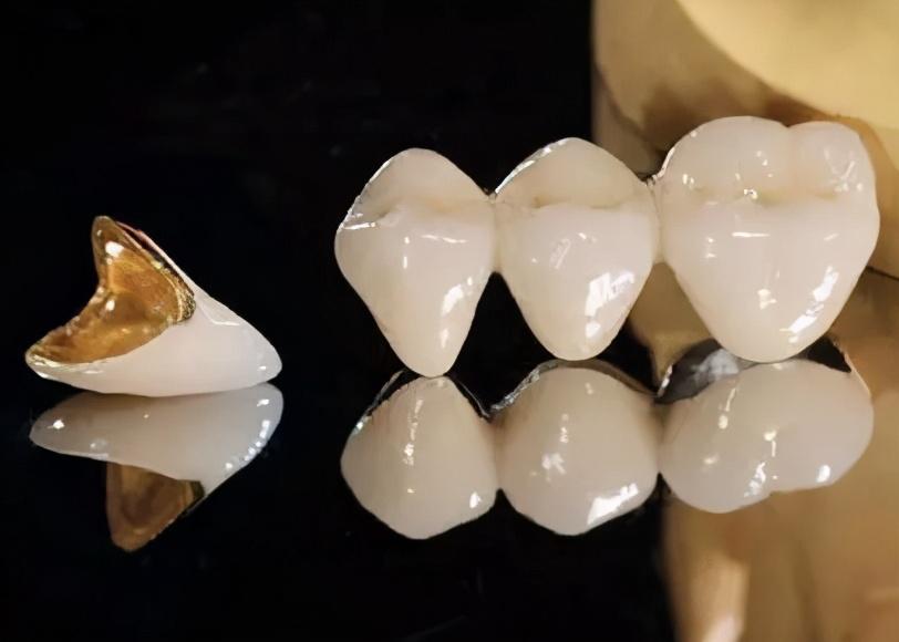 烤瓷牙，美丽背后的秘密与选择