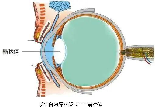 矫正视力手术，价格、选择与考量