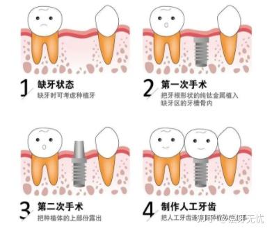种植牙费用解析